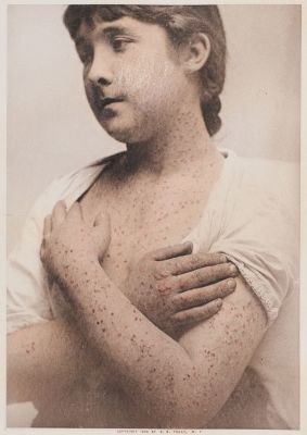 Scabies