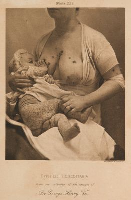 Plate XII Syphilis Haereditaria