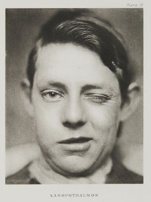 Plate IV,  Lagophthalmos