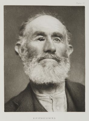 Plate IX, Epithelioma