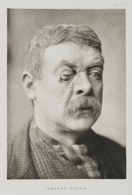 Plate X, Rodent Ulcer