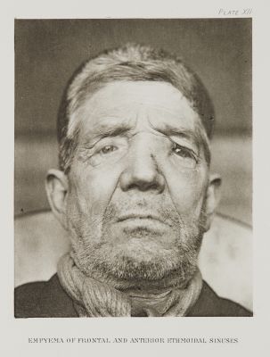 Plate XII, Empyema of Frontal and Anterior Ethmoidal Sinuses