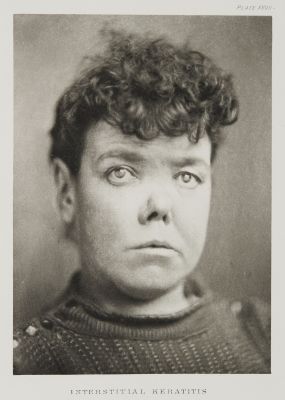 Plate XXVII, Interstitial Keratitis