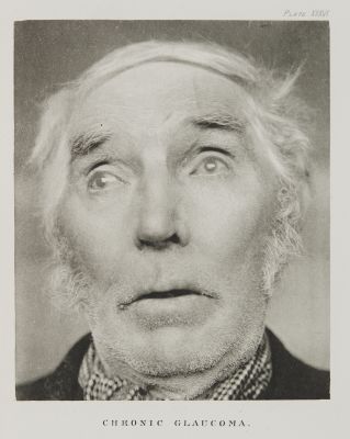 Plate XXXVI, Chronic Glaucoma