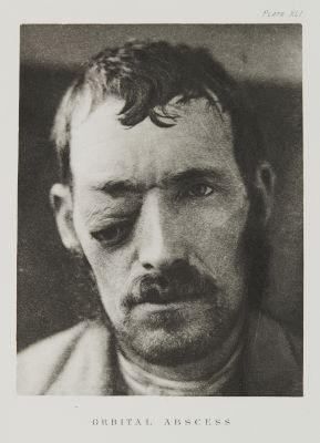 Plater XLI, Orbital Abscessf