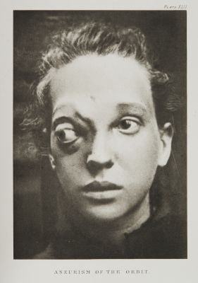 Plate XLII, Aneurism of the Orbit