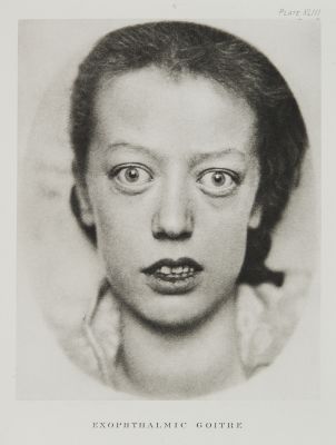Plate XLIII, Exophthalmic Goitre