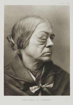 Plate XLVI, Sarcoma of the Choroid