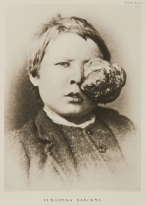 Plate XLVIII, Fungating Sarcoma