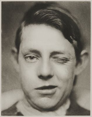 Plate IV,  Lagophthalmos