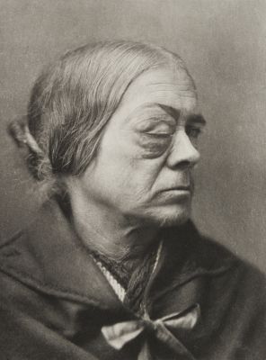 Plate XLVI, Sarcoma of the Choroid