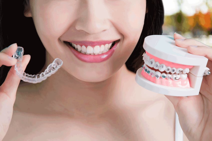 Clear Aligners Versus Traditional Braces