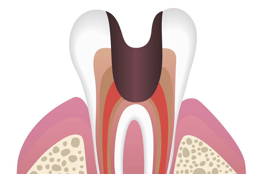 The 5 Stages of Dental Caries