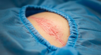 Інфекція хірургічної рани: лікування і методи профілактики