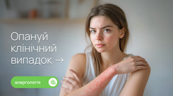 Уртикарний висип із епізодом набряку Квінке в 23-річної пацієнтки