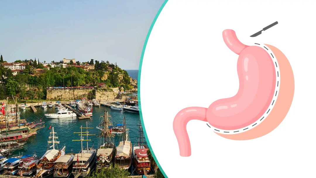Gastric Sleeve Surgery in Turkey