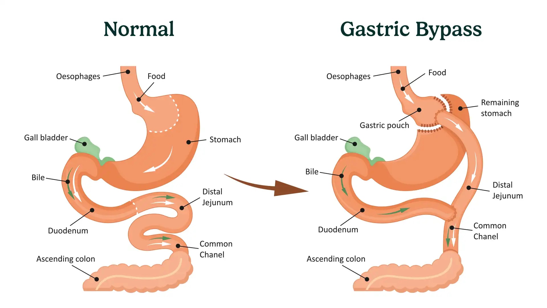 Diagram of a normal stomach compared with gastric bypass.