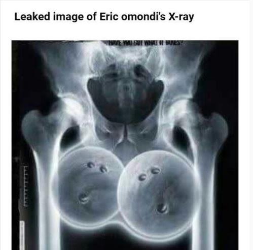 Leaked image of eric omondi's xray