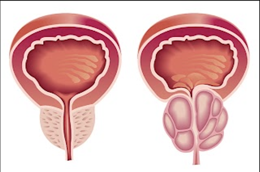 Enucléation au laser de la prostate (HOLEP)