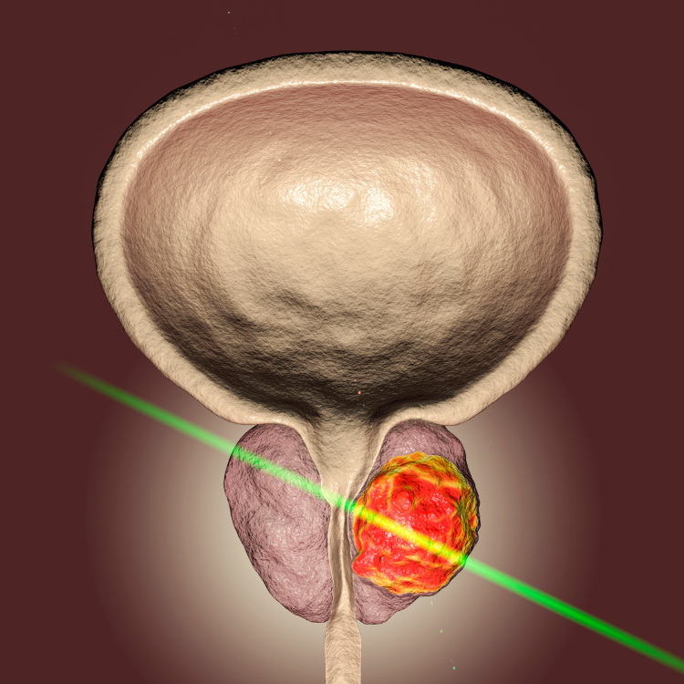Laser de la prostate