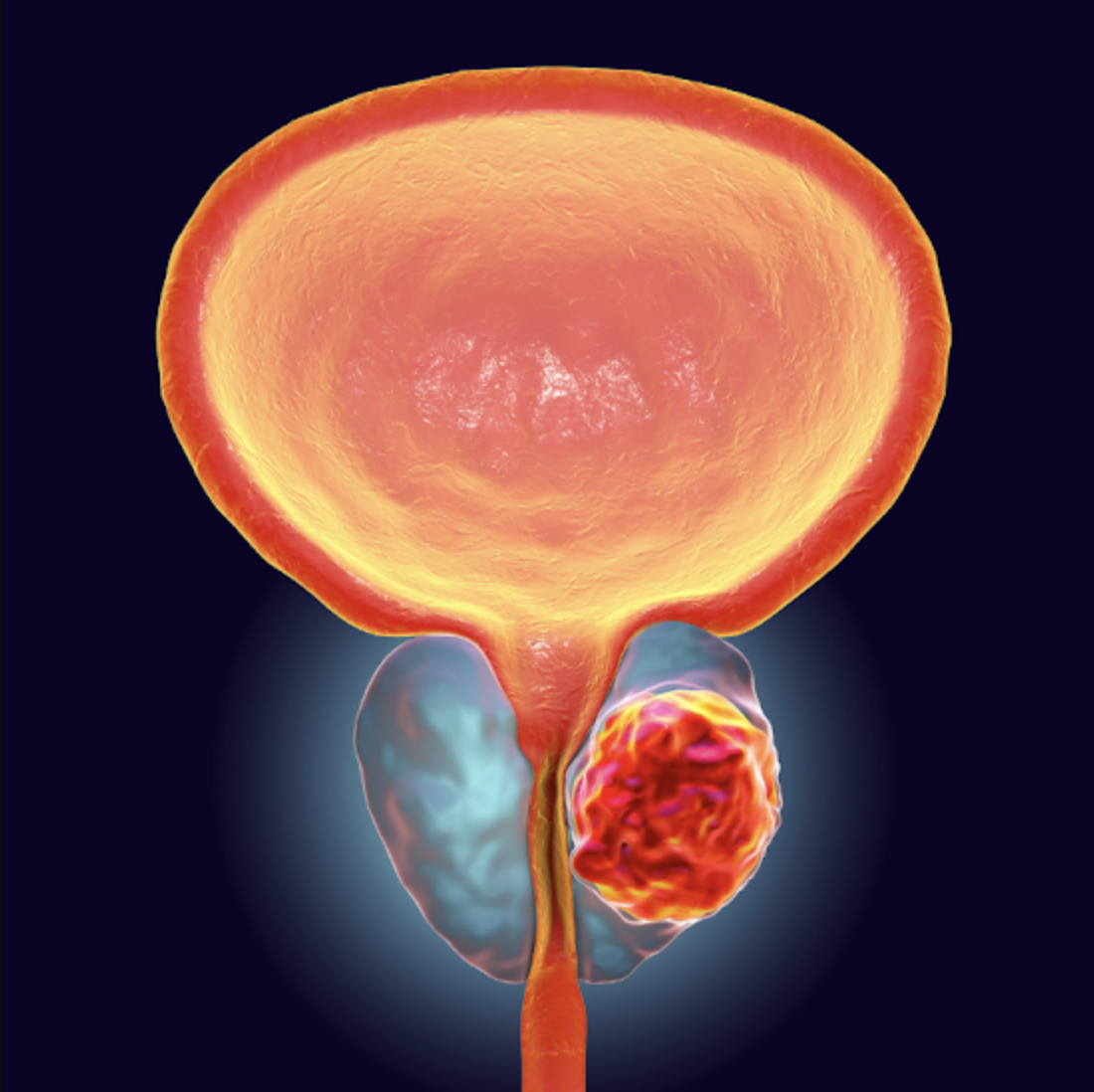 Cancer de la prostate