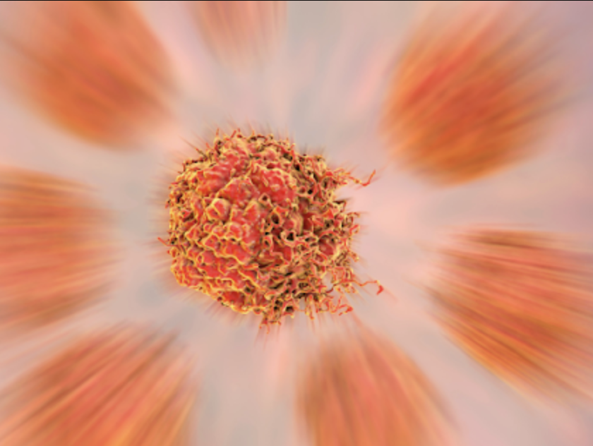 Cancer de la prostate