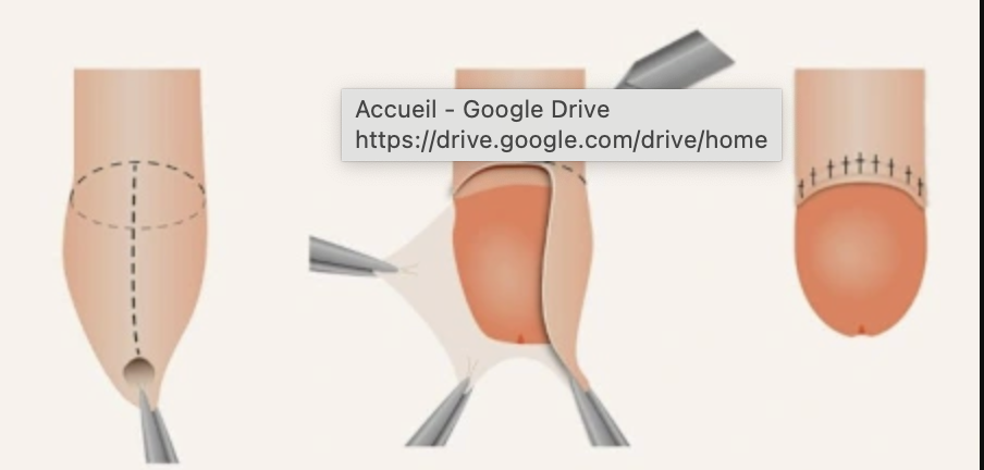 Circoncision