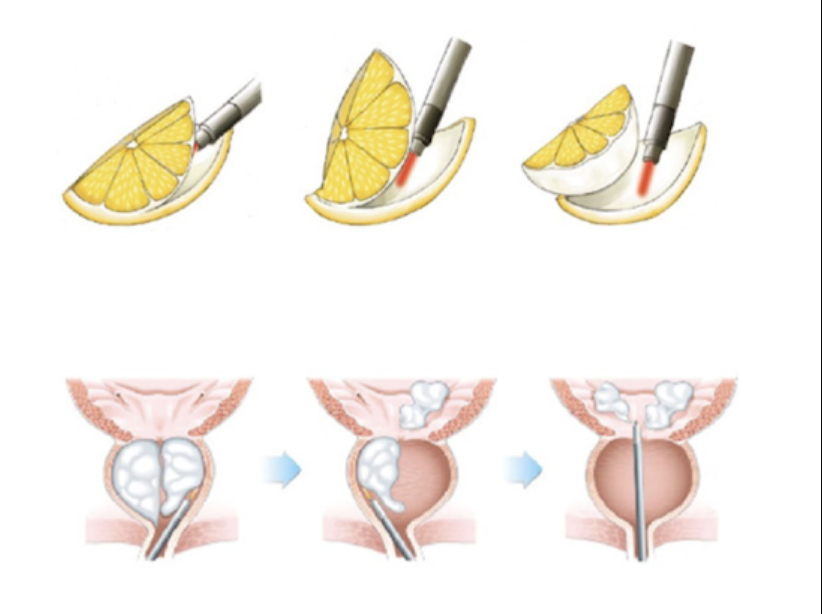 Laser de la prostate