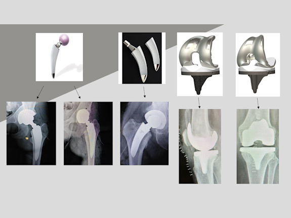 Up to 70% of Orthopedic Medtech Company to Be Sold