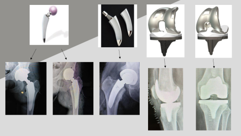 Up to 70% of Orthopedic Medtech Company to Be Sold