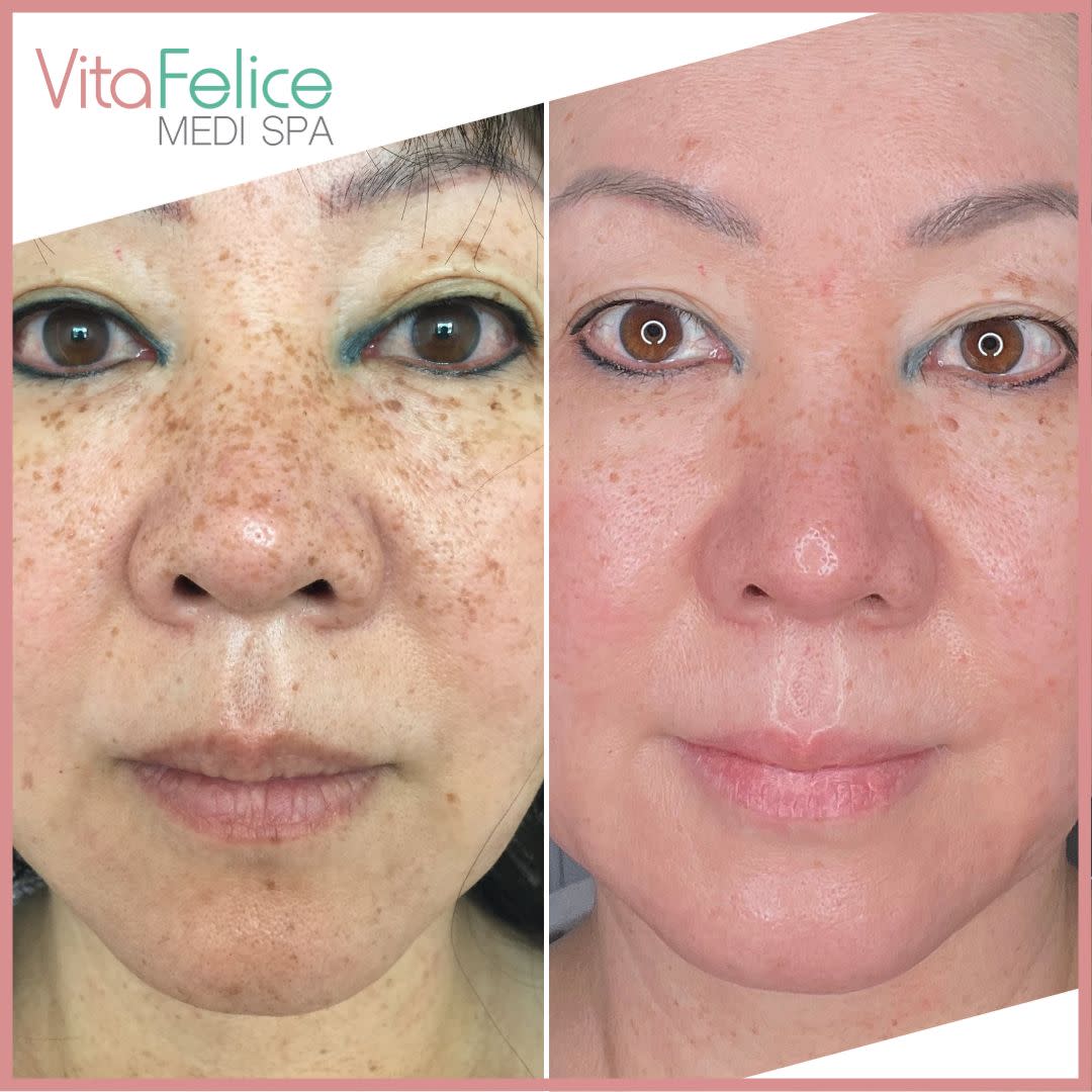 Medi Spa Treatments for pigmentation