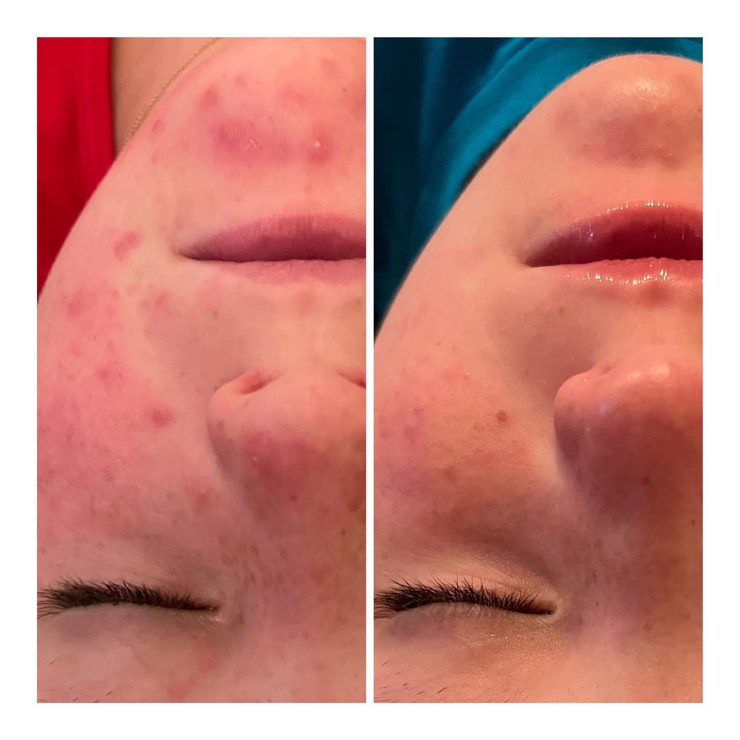 Acne treatment using Jet Plasma and Neo Genesis products!