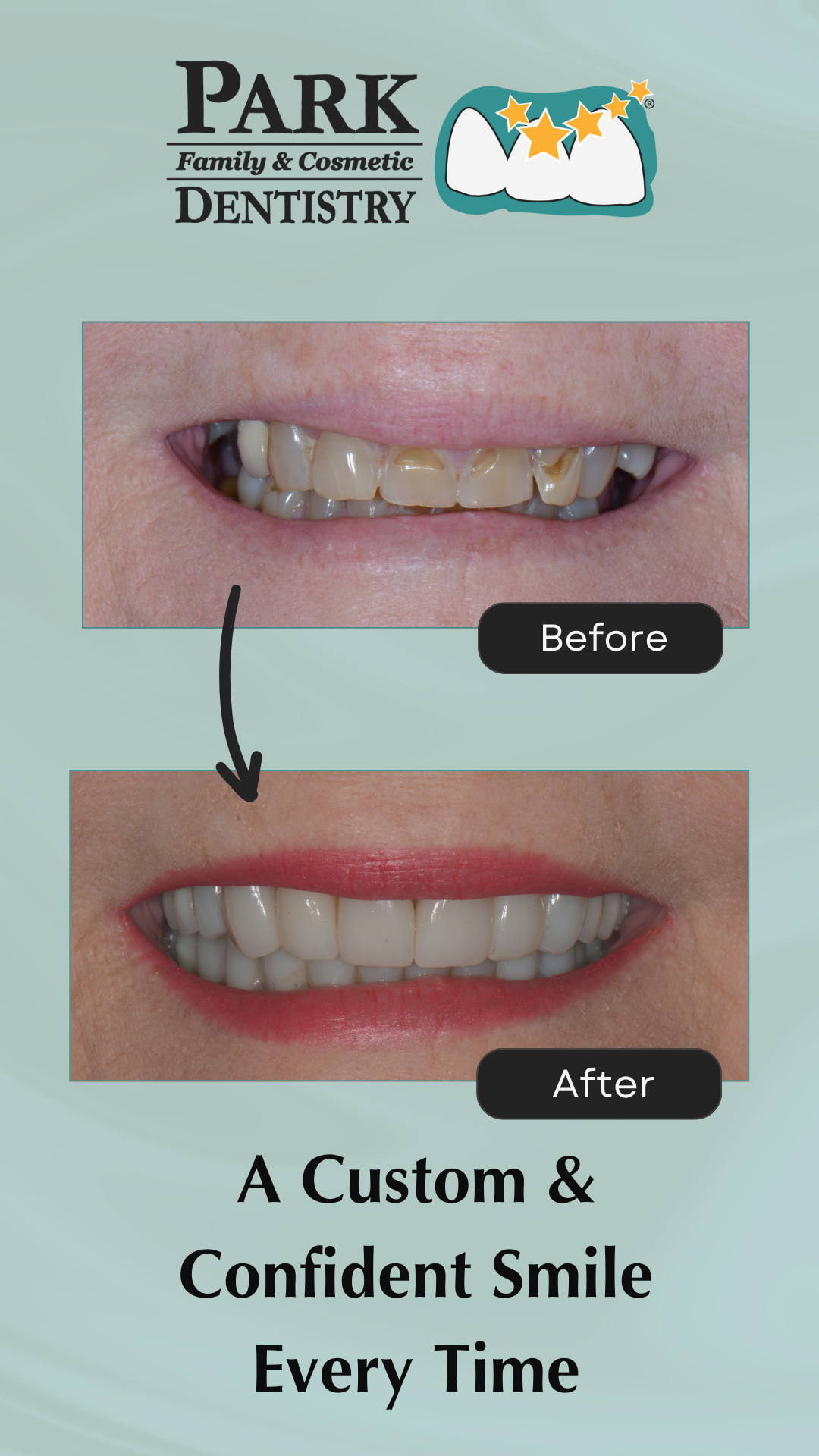 Crowns and Implants