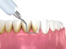 Dental Checkup and Cleaning in Brooklyn NY