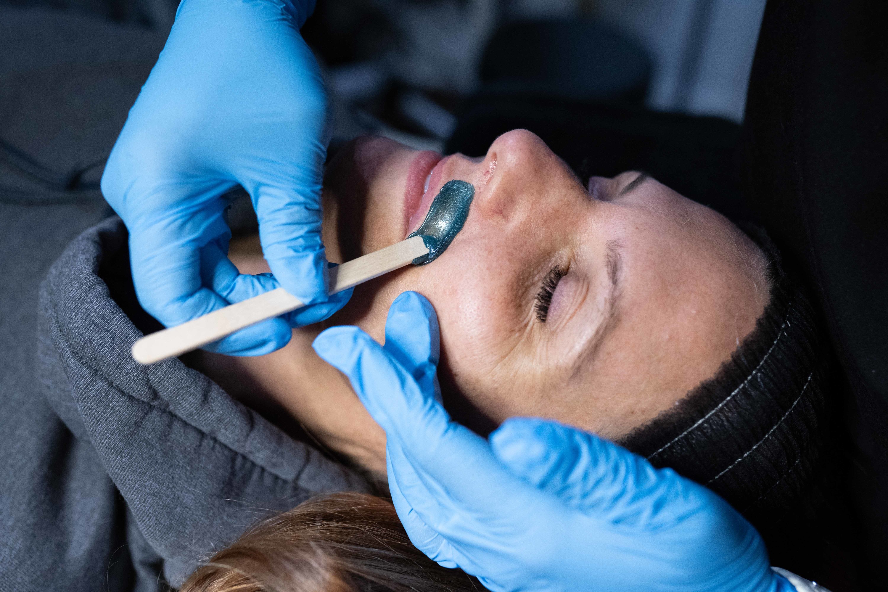 Close-up of a client’s upper lip receiving warm soft-wax removal by a blue-gloved clinician