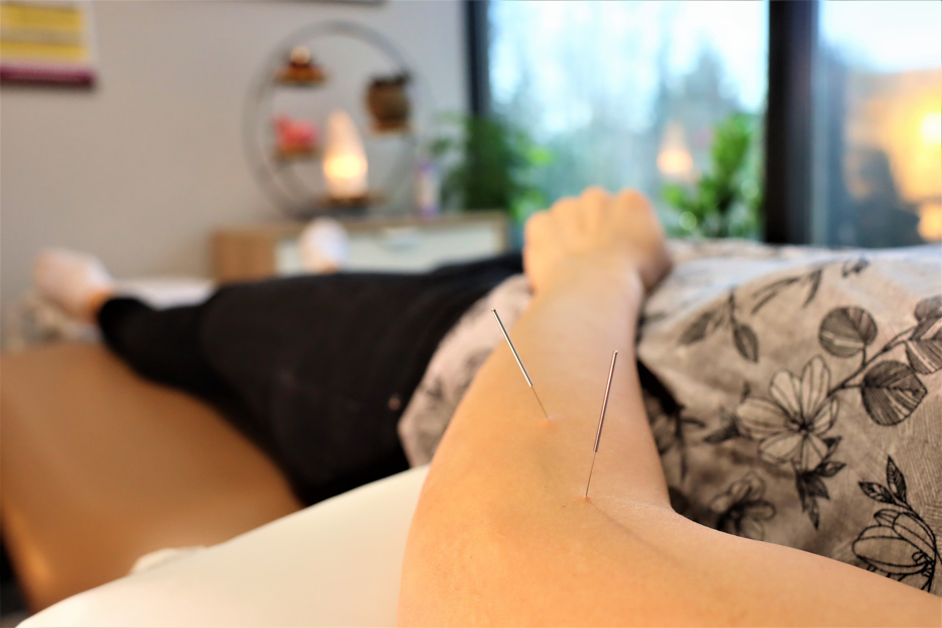 Burnaby Acupuncture