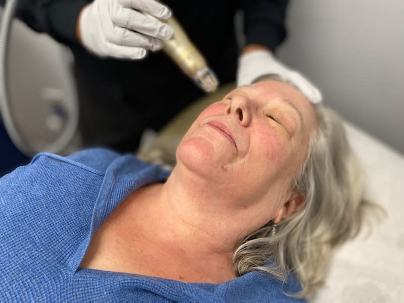 Woman receiving a Sylfirm X RF microneedling treatment at a med spa, lying down as a provider gently applies the device face.
