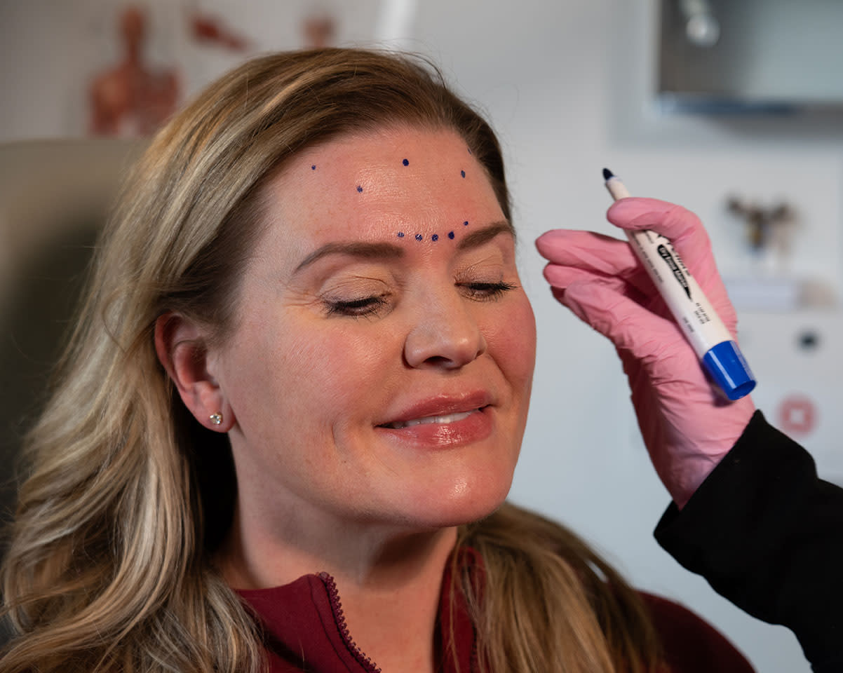 Patient with small blue dots marking Xeomin injection points on her forehead while a pink-gloved hand holds a marker near her