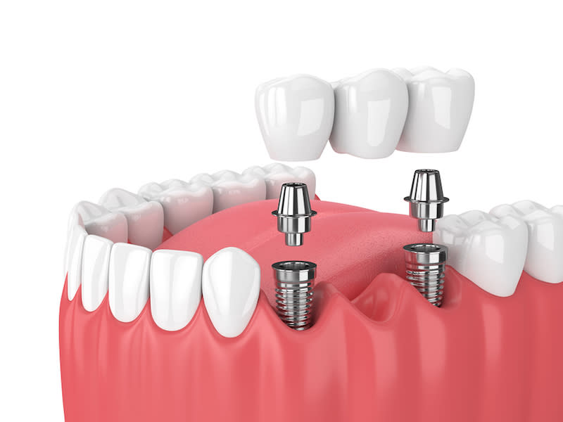 Implant supported Dental Bridge