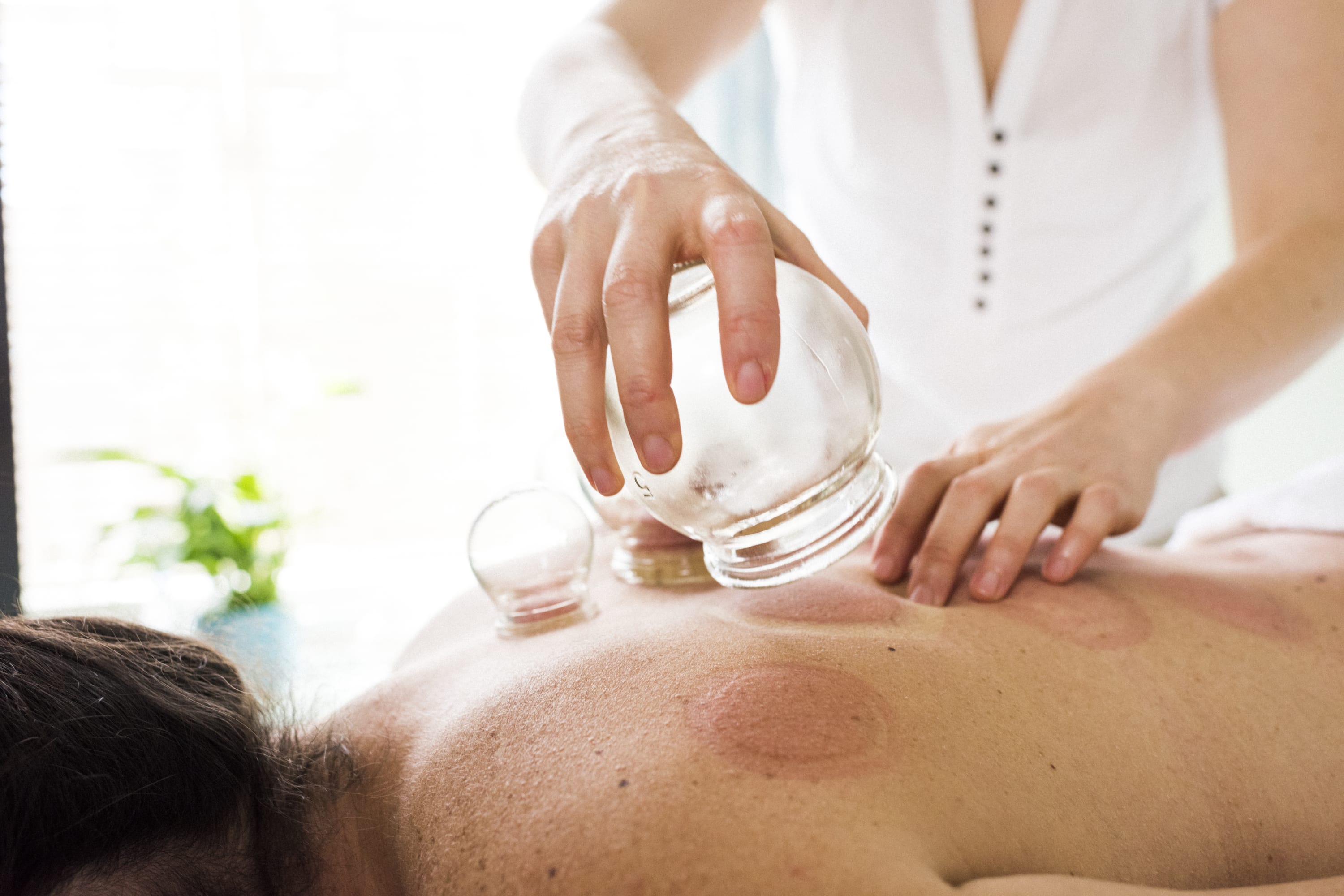 Cupping therapy treatment at Magnus Health and Wellness in Richmond, BC