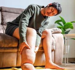 Man suffering from Lymphedema