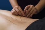 What is Dry Needling?