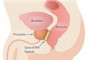 SpaceOAR system