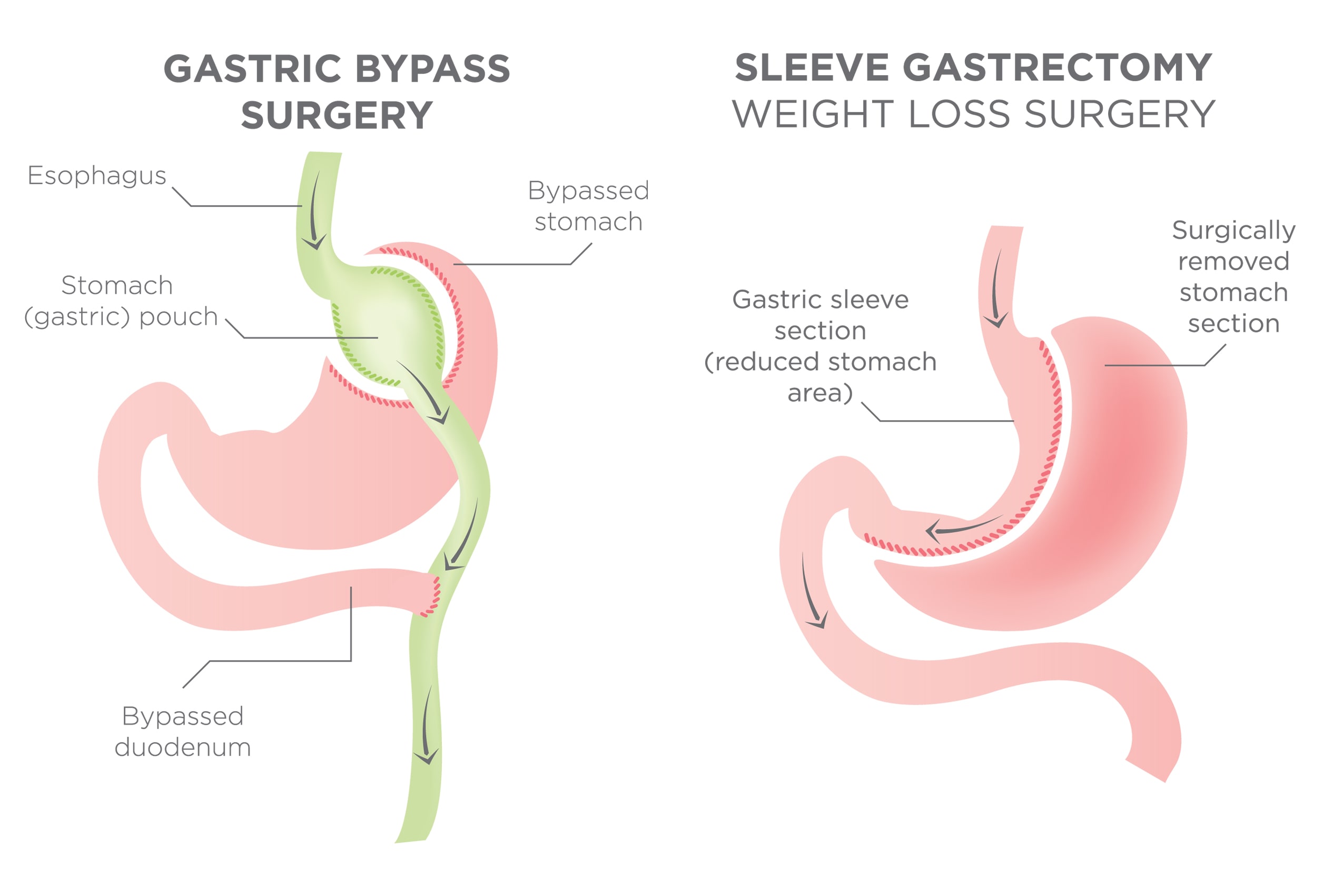 Illustration of bypass and sleeve surgery