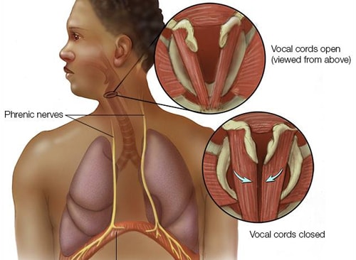 hiccups-diagram