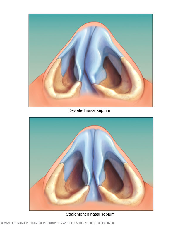 La sequedad intranasal, un problema habitual en los deportistas