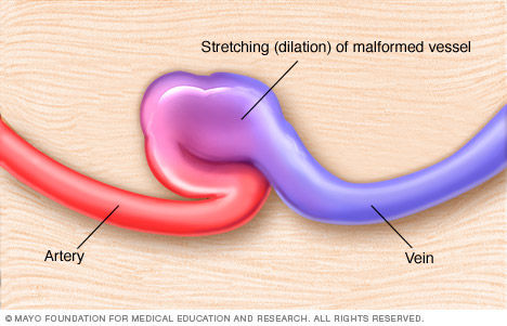 Fístula arteriovenosa