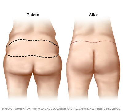 Community Medical Centers - Buttock Augmentation & Lift