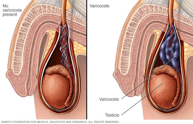 varicocele dor