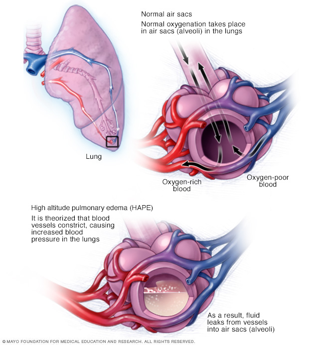 Edema pulmonar de las alturas